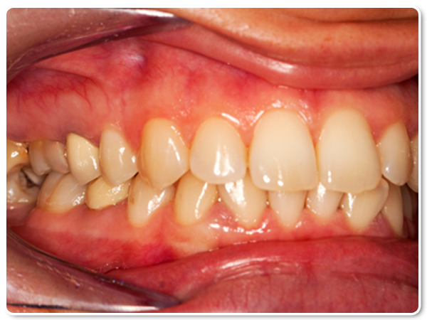 severe gum disease