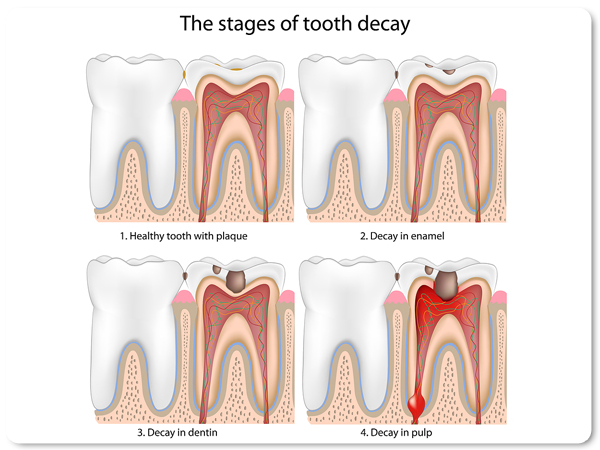 stop tooth root decay
