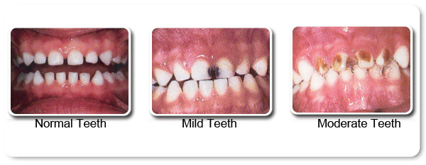 tooth decay baby teeth treatment