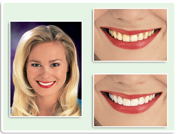 Clear Correct- clear braces -, Prestonwood Dental