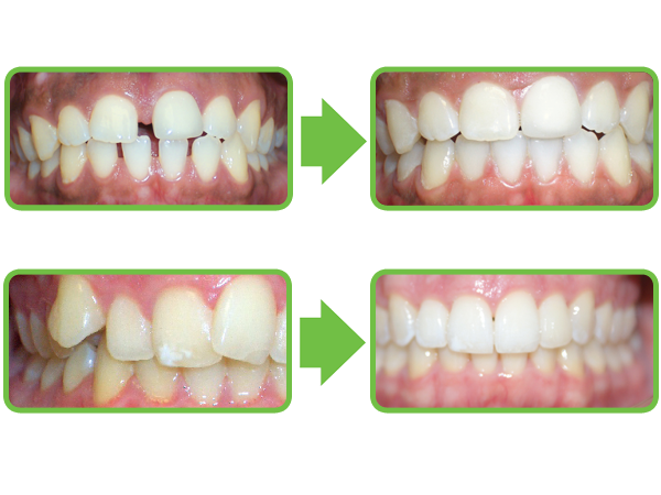 Clear Correct- clear braces -, Prestonwood Dental
